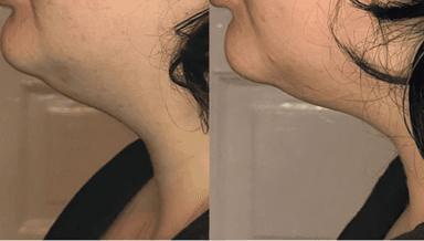 Image for Intro Chin Slimming/Cryofacial